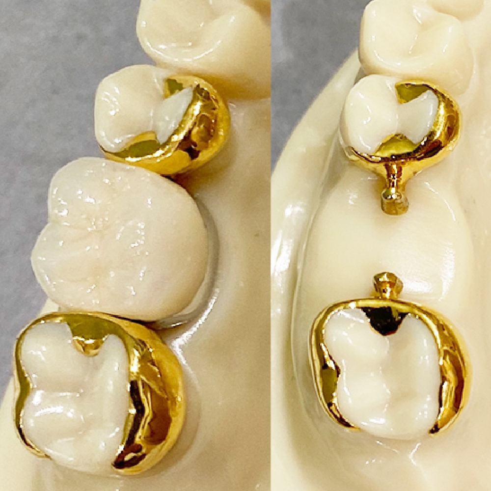 歯をほとんど削らず、神経も残すことができ、取り外しも必要なし